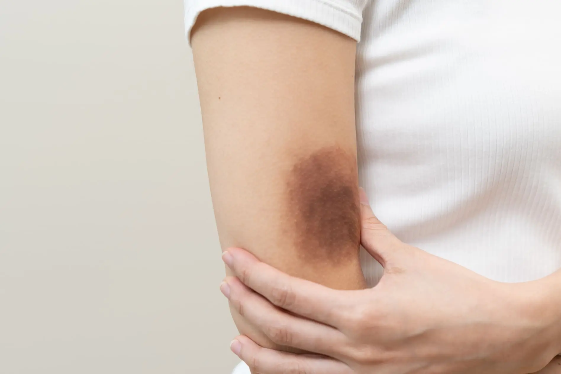 O que causa hematoma espontâneo pelo corpo?